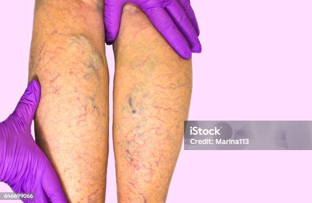 Lower Limb Vascular Examination Because Suspect Of Venous Insufficiency Stock Photo - Download Image Now