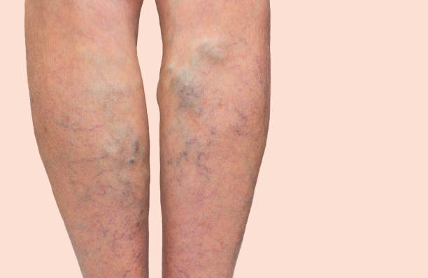 spataderen op een vrouwelijke benen - woman legs veins stockfoto's en -beelden