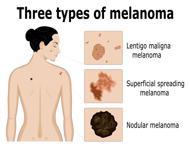 Three types of melanoma Three types of melanoma that for example located on the back and face of the woman melanoma stock illustrations