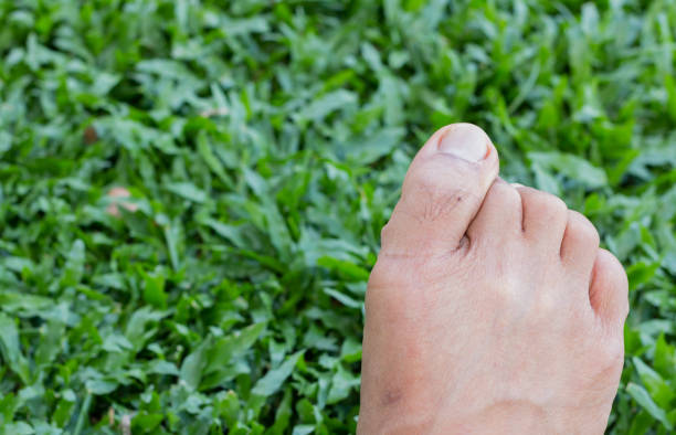 démangeaisons des pieds sur fond d’herbe verte - podiatry human foot grass barefoot photos et images de collection