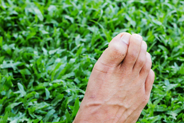 démangeaisons des pieds sur fond d’herbe verte - podiatry human foot grass barefoot photos et images de collection