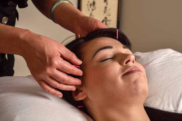 istock Acupuncture treatment on head and temples 648551446