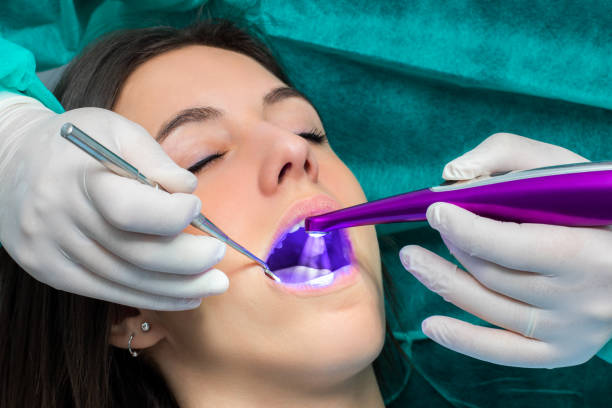 Dentist preventing tooth decay with led curing light on girl. Macro close up of hand working on female teeth with blue led curing light. sealant photos stock pictures, royalty-free photos & images