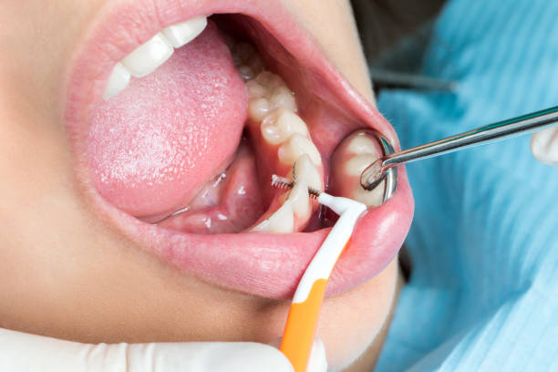 istock Macro close up of interdental cleaning on human teeth. 648722054