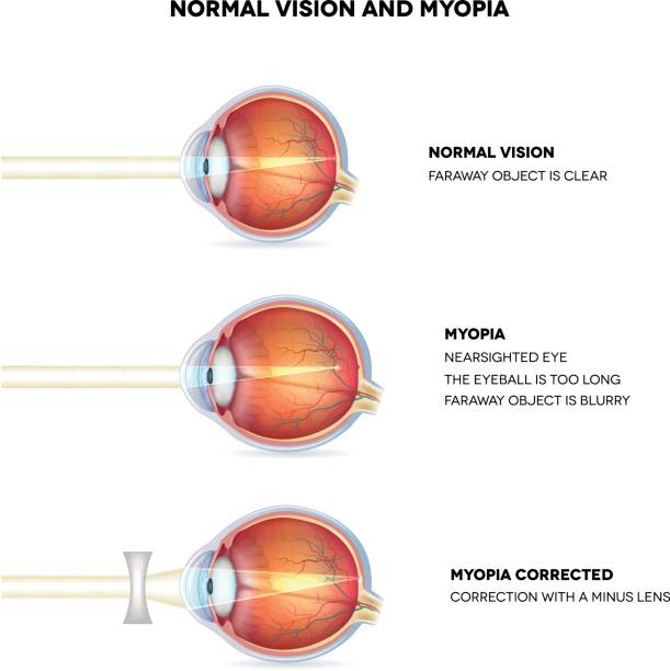 krótkowzroczność i normalne widzenie. krótkowzroczność jest krótkowzroczna. - krótkowzroczność stock illustrations