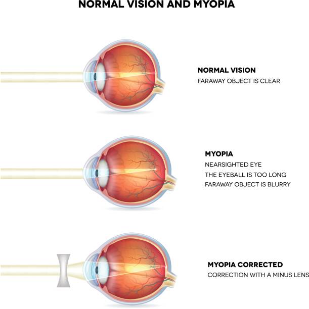 Myopia and normal vision. Myopia is being shortsighted. Myopia and normal vision. Myopia is being shortsighted. Myopia corrected with minus lens. Anatomy of the eye, cross section. Detailed illustration. myopia stock illustrations