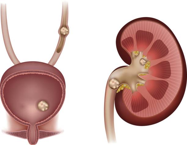 ilustrações, clipart, desenhos animados e ícones de stones in the rim, urinária de butil e ureter - kidney stone