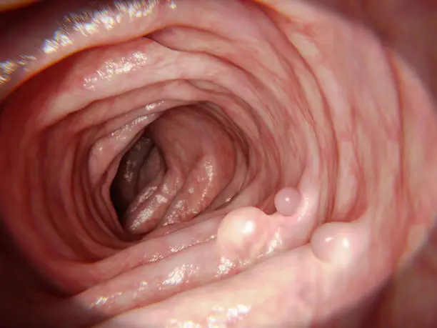 Polyps are a growth of tissue occurring on the lining of the colon or rectum.Untreated colorectal polyps can develop into colorectal cancer.