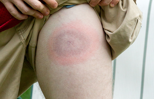 very large Lyme disease bullseye appears on young mans leg
