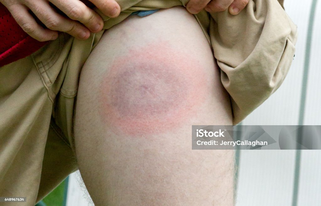 Lyme disease bullseye on young mans leg very large Lyme disease bullseye appears on young mans leg Lyme Disease Stock Photo