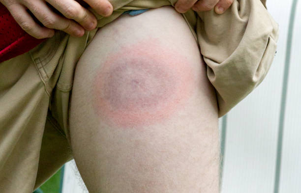 Lyme disease bullseye on young mans leg very large Lyme disease bullseye appears on young mans leg lyme disease photos stock pictures, royalty-free photos & images