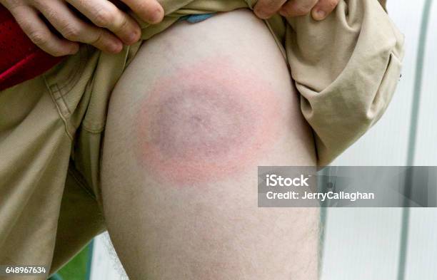 Lyme Disease Bullseye On Young Mans Leg Stock Photo - Download Image Now - Lyme Disease, Tick - Animal, Crop Sprayer