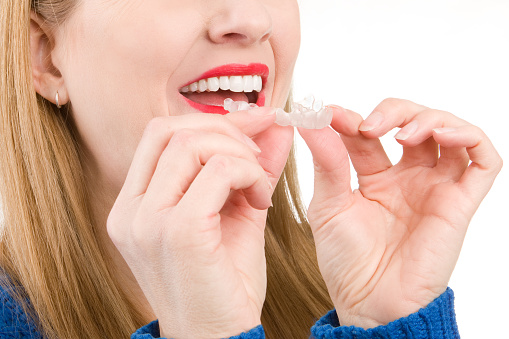 A woman putting clear dental braces on her teeth.