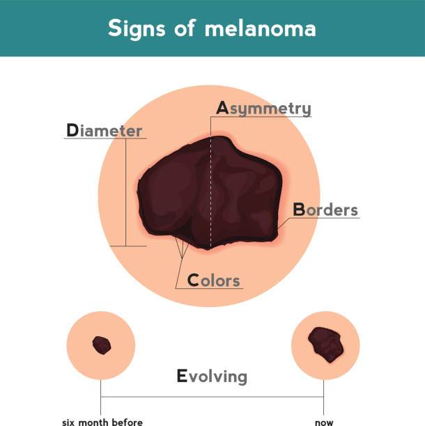 Melanoma ABCDE signs. Vector illustration of skin patch with skin cancer Vector illustration of skin patch with skin cancer melanoma stock illustrations
