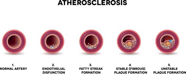 Atherosclerosis formation Atherosclerosis formation. Healthy artery and unhealthy arteries, showing step by step how  plaque is developing. Very detailed illustration of fatty streak formation, white blood cells infiltration, blood clot formation etc. clogged artery stock illustrations