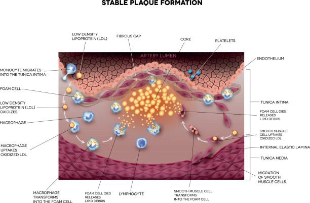 ilustraciones, imágenes clip art, dibujos animados e iconos de stock de formación estable de placas en la arteria humana - lipoprotein