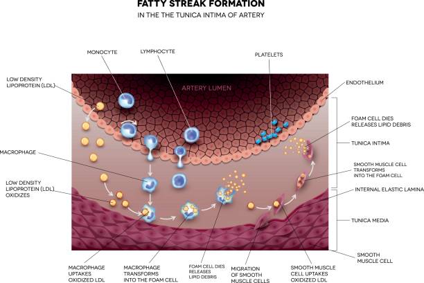 Fatty streak formation in the artery Fatty streak formation in the artery. It may lead to thrombosis, formation of a blood clot inside artery. endothelial stock illustrations