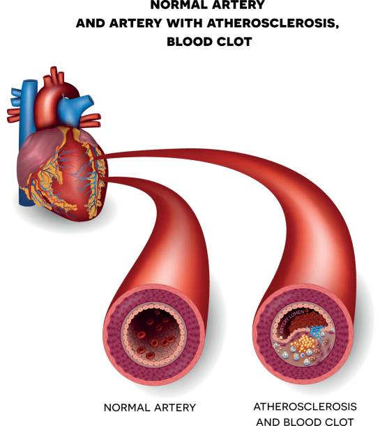 Normal artery and unhealthy artery with blood clot Normal artery and unhealthy artery with blood clot. Plaque rupture detailed anatomy illustration. Artery lumen is narrowed and lead to thrombosis clogged artery stock illustrations