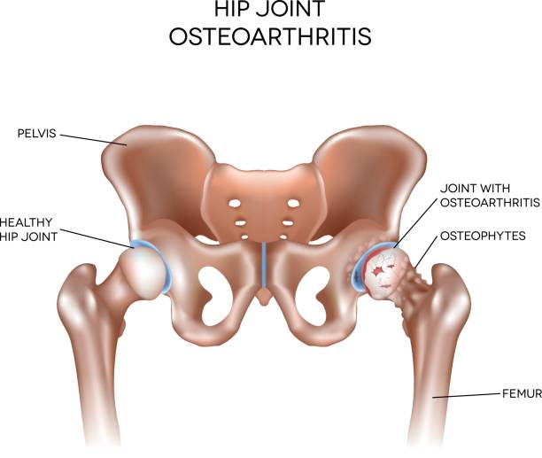 zapalenie stawów stawu biodrowego - biodro stock illustrations