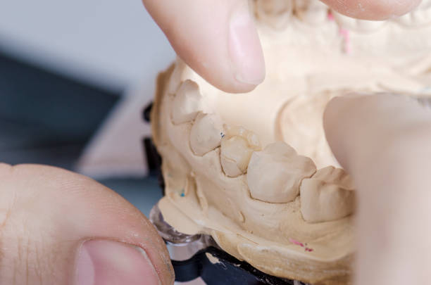 istock Dental technician putting a ceramic tooth in a dental cast model. 650842138