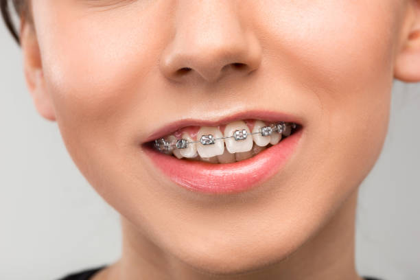istock Beautiful young woman with teeth braces 651345744
