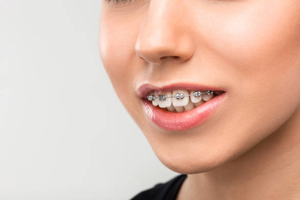 istock Beautiful young woman with teeth braces 651345924