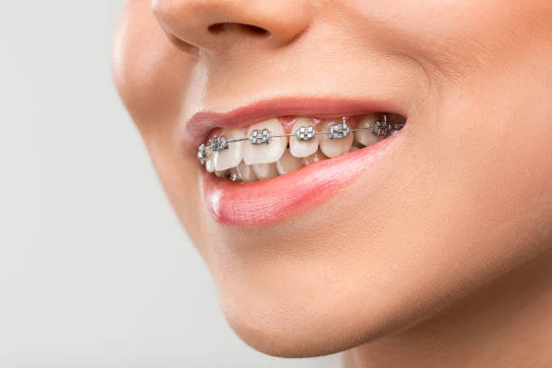 istock Beautiful young woman with teeth braces 651346146