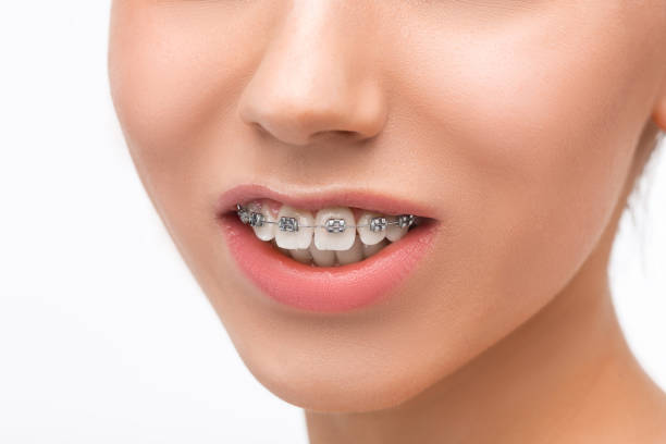 istock Beautiful young woman with teeth braces 651346394