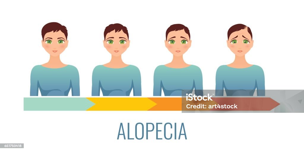 Conjunto de etapas de alopecia femenina. - arte vectorial de Adulto libre de derechos