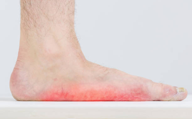 Male leg with strongly pronounced flat feet. Men with signs of flatfoot foot and nail fungus. Foot Diseases. Fungal disease. statin photos stock pictures, royalty-free photos & images