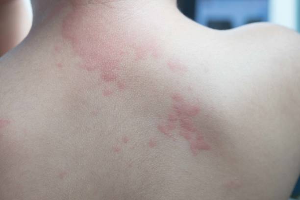 Close up image of  boy's body suffering severe urticaria, nettle rash. Close up image of  boy's body suffering severe urticaria, nettle rash. shingles rash stock pictures, royalty-free photos & images