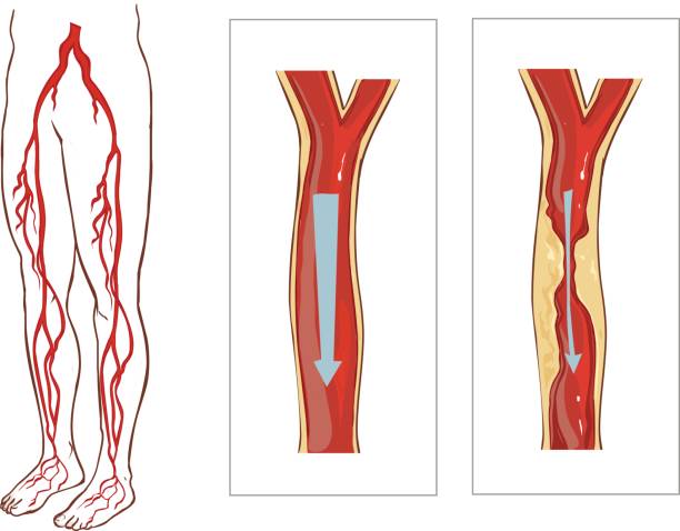 ilustrações de stock, clip art, desenhos animados e ícones de vector illustration of avascular system legs. - adipose cell