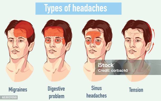 Illustration About Headaches 4 Type On Different Area Of Patient Head Stock Illustration - Download Image Now