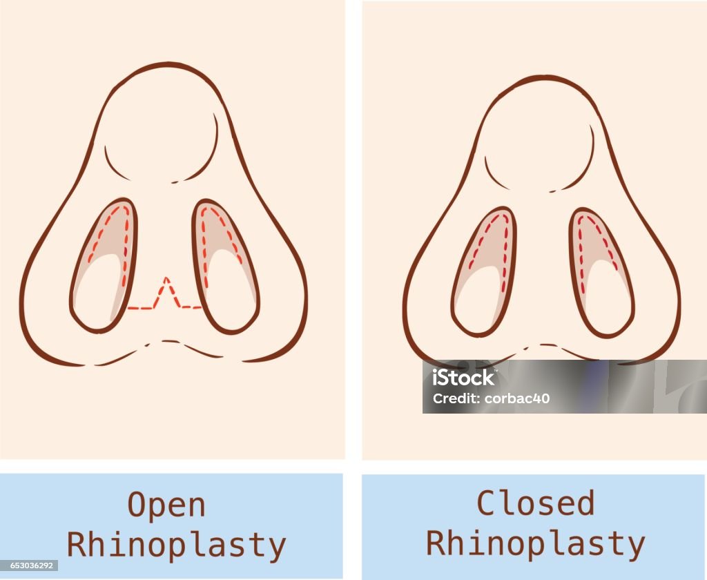 Vector illustration of a anatomy Rhinoplasty technique Anatomy stock vector