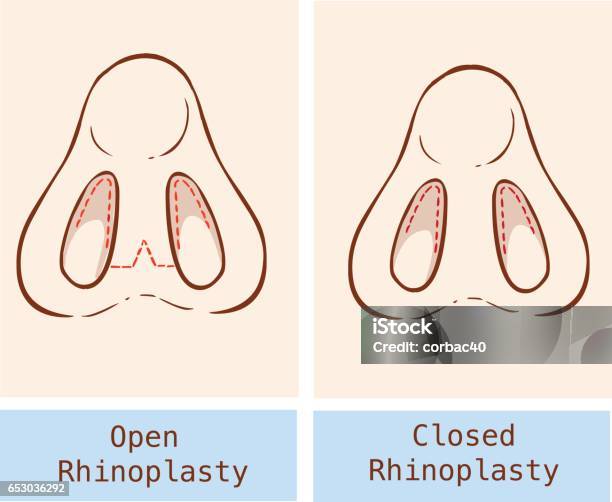 Vector Illustration Of A Anatomy Rhinoplasty Technique Stock Illustration - Download Image Now