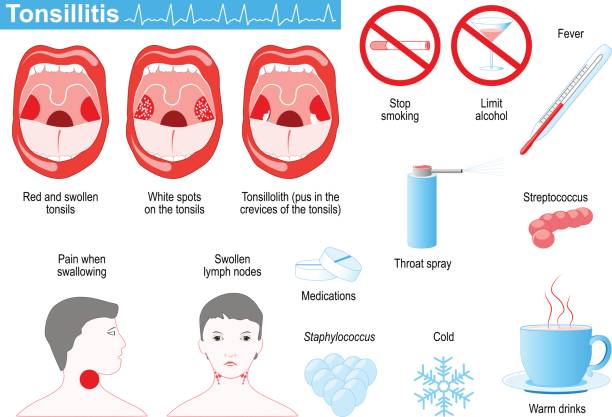 tonsillitis infographic tonsillitis infographic. Signs, symptoms and Treatment. icons set. tonsil stock illustrations