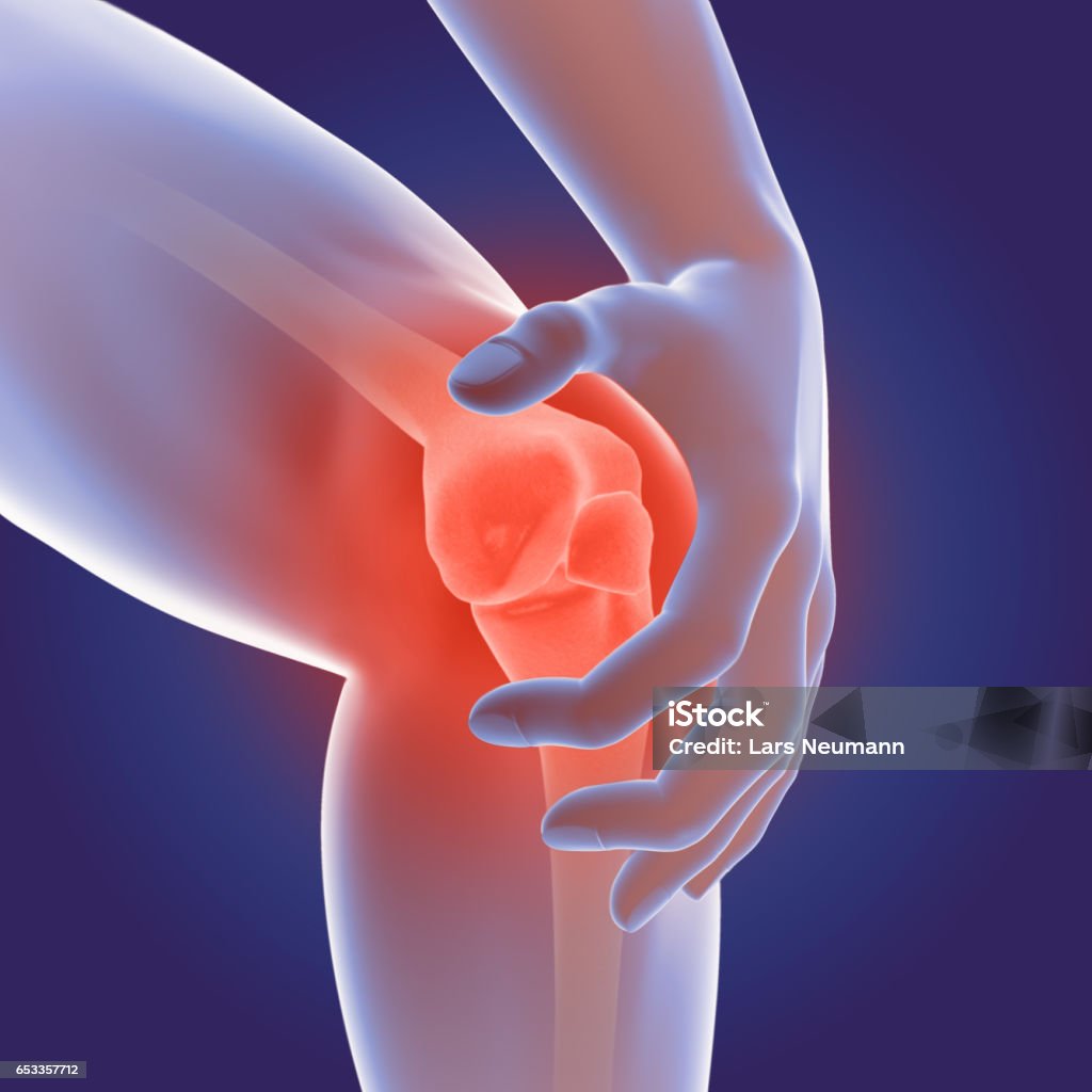 3D Render of Osteoarthritis - rheumatoid arthritis in the human knee joint Rheumatoid Arthritis Stock Photo