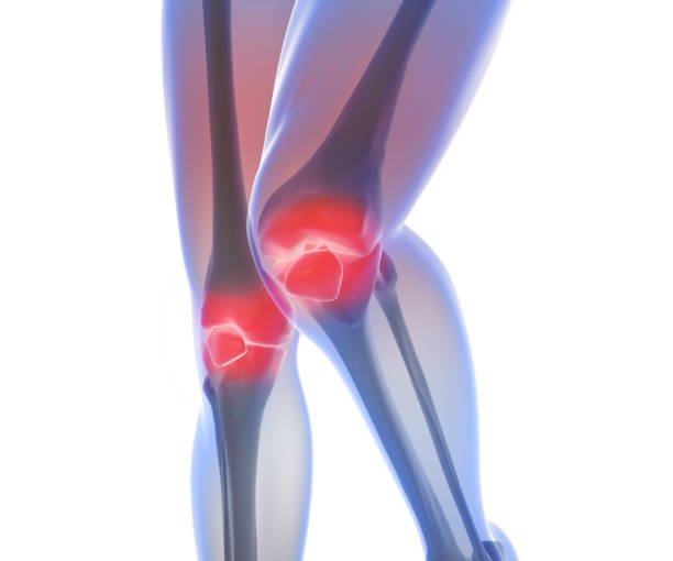 istock 3D Render of Osteoarthritis - rheumatoid arthritis in the human knee joint 653357740