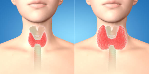 3d render нормальных щитовидных желез и зоб в организме человека - goiter стоковые фото и изображения