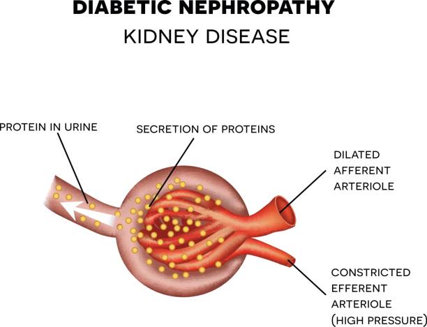 당뇨병 성 신병증, 구종 해부학 - glomerulus stock illustrations