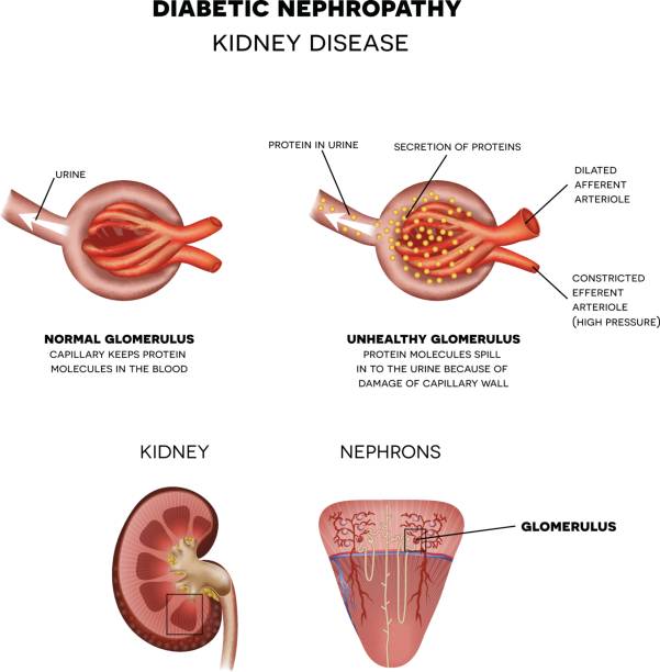 illustrazioni stock, clip art, cartoni animati e icone di tendenza di nefropatia diabetica, malattia renale - glomerulus