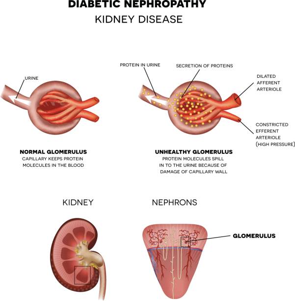 당뇨병 성 신장 병증, 신장 질환 - glomerulus stock illustrations