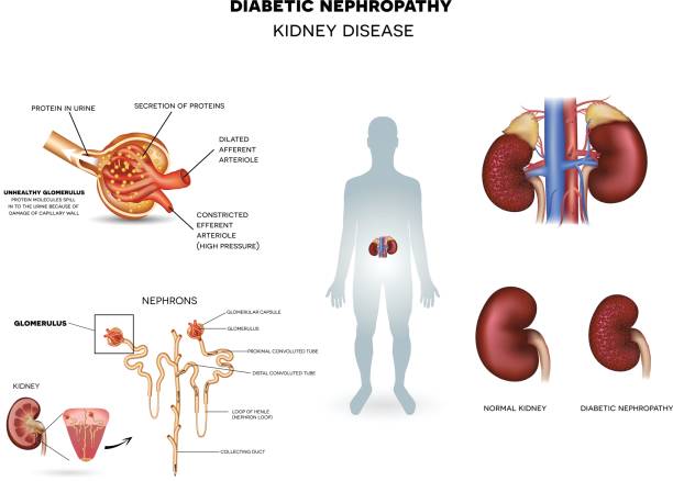 diabetische nephropathie, nierenerkrankung - tierische arterie stock-grafiken, -clipart, -cartoons und -symbole