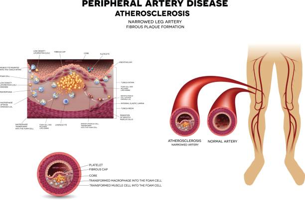 Leg artery disease, Atherosclerosis Leg artery disease, Atherosclerosis, narrowed artery by the fatty streak, plaque on the inner surface of the artery. atherosclerosis stock illustrations