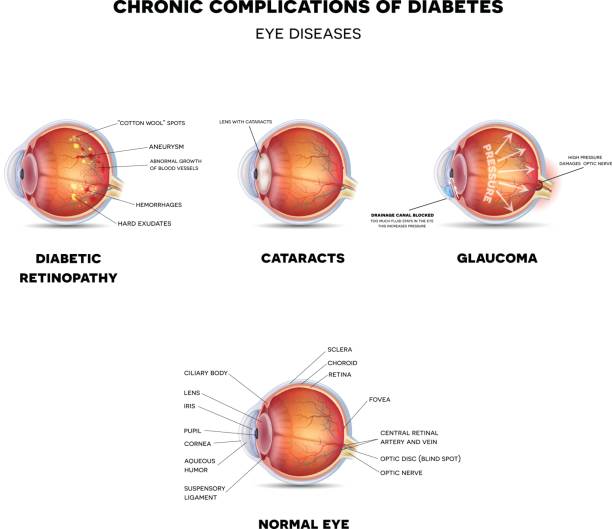 illustrazioni stock, clip art, cartoni animati e icone di tendenza di malattie degli occhi diabetici - cataratta