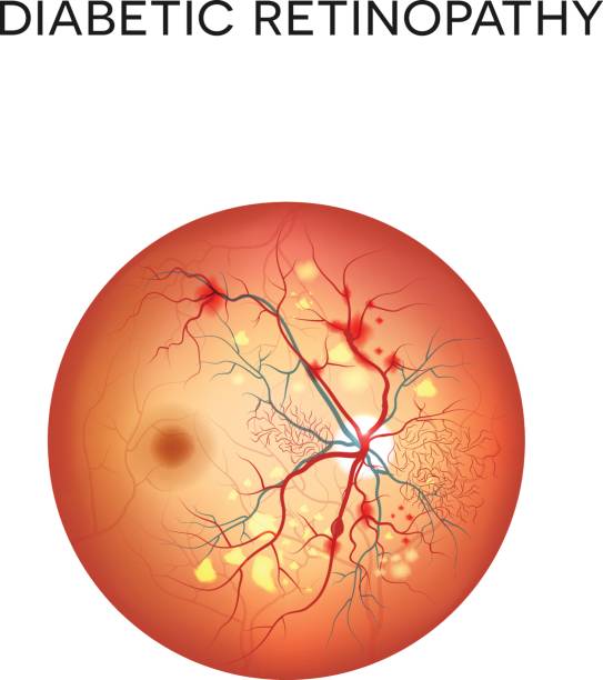 Diabetic retinopathy Diabetic retinopathy. The eye condition that affect people with diabetes. Illustration of the retina of the eye retina stock illustrations