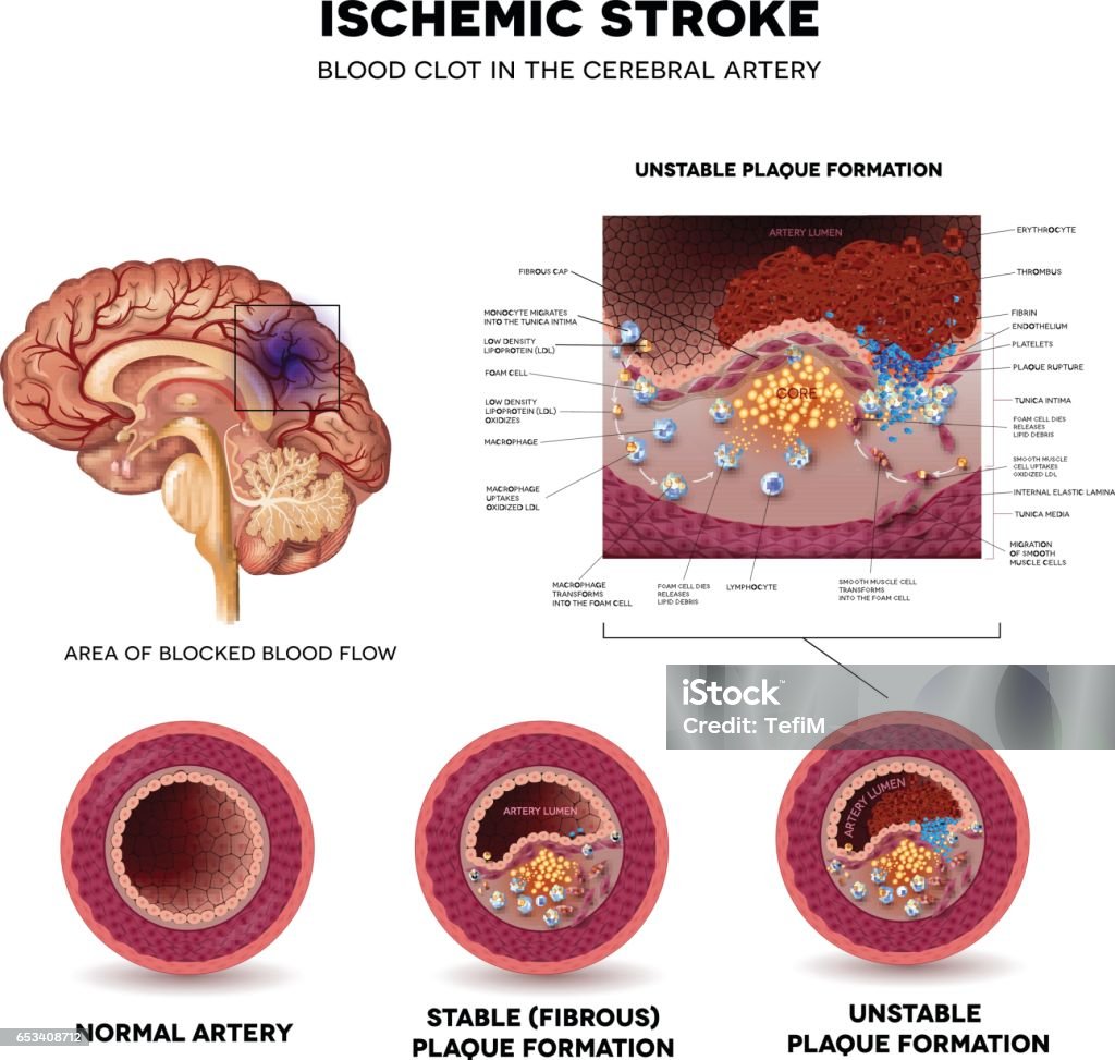 Stroke Ischemic stroke in the cerebral artery. Stable and Unstable plaque formation and thrombus. Stroke - Illness stock vector