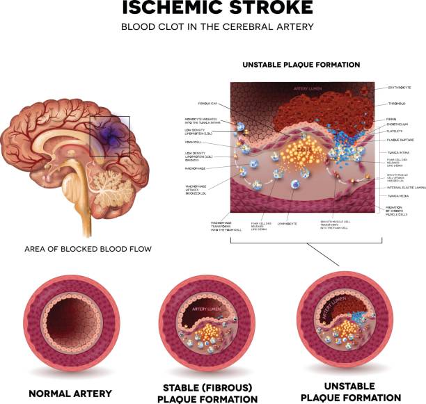 Stroke Ischemic stroke in the cerebral artery. Stable and Unstable plaque formation and thrombus. stroke illness illustrations stock illustrations