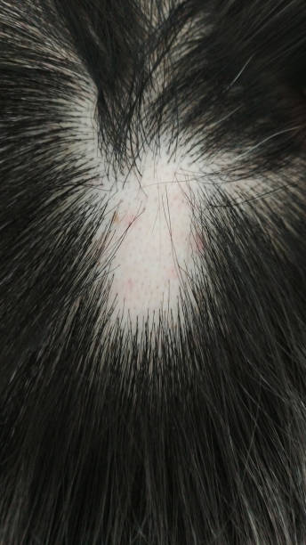 istock Hair loss, alopecia 653412938