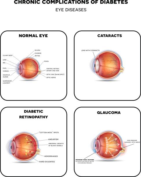 illustrazioni stock, clip art, cartoni animati e icone di tendenza di diagramma delle malattie degli occhi diabetici - cataratta